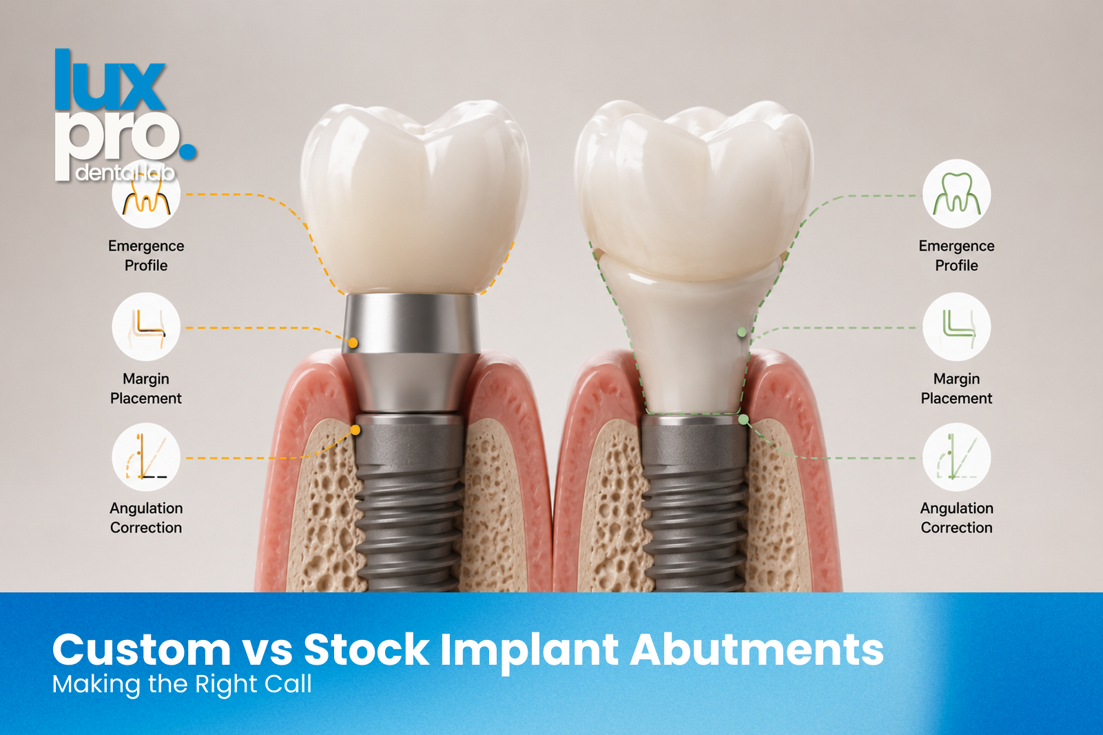 Stock implant abutment compared to a CAD/CAM custom abutment showing emergence profile, margin placement, and angulation differences.
