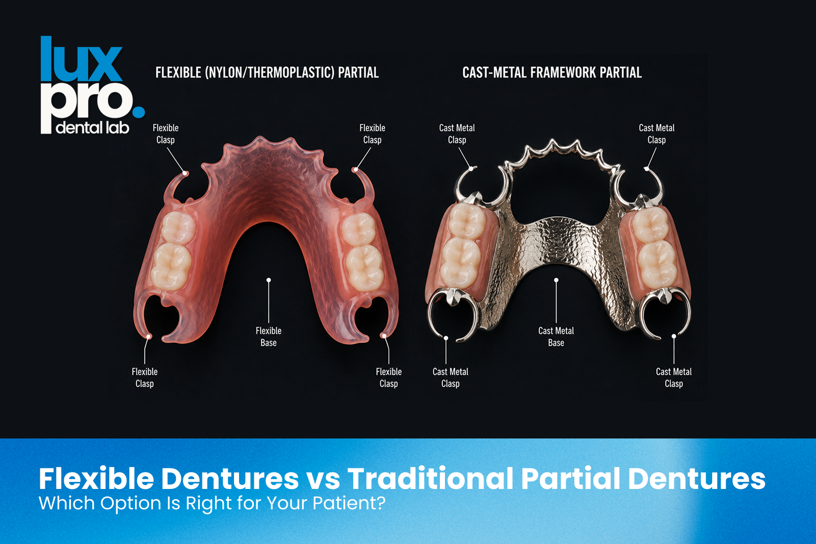 Comparison of a flexible thermoplastic partial denture and a traditional cast metal framework partial denture.