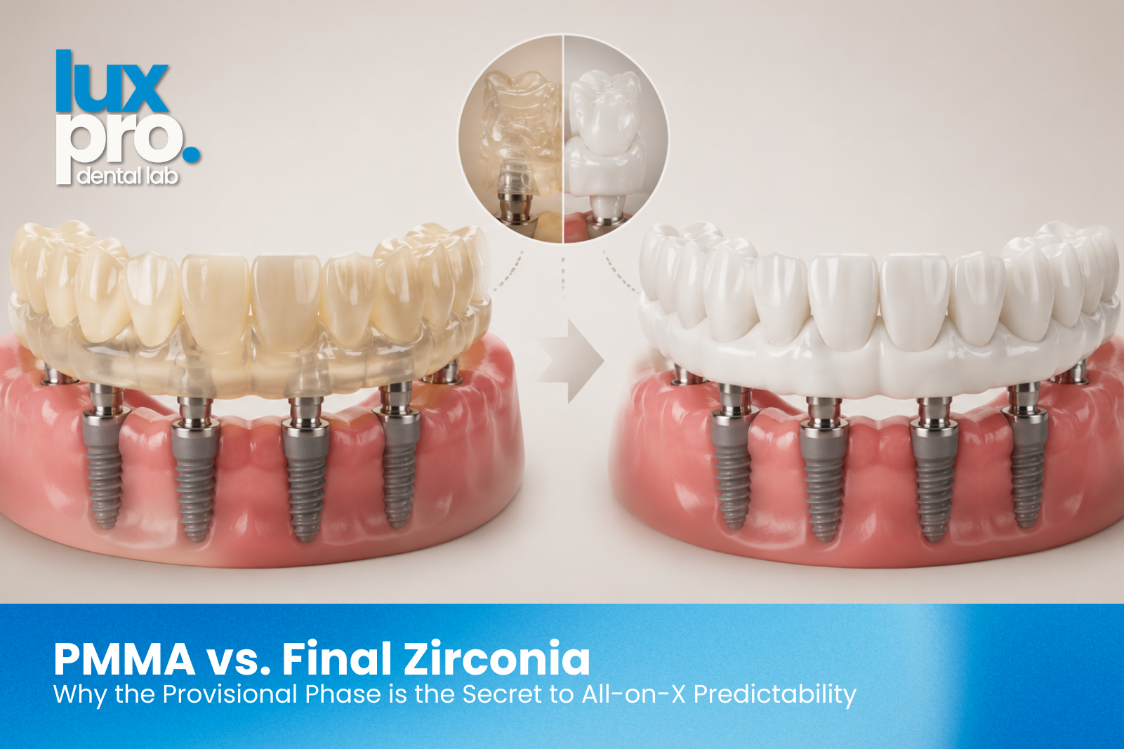 PMMA provisional and final zirconia All-on-X dental implant restorations shown side by side on a neutral background.