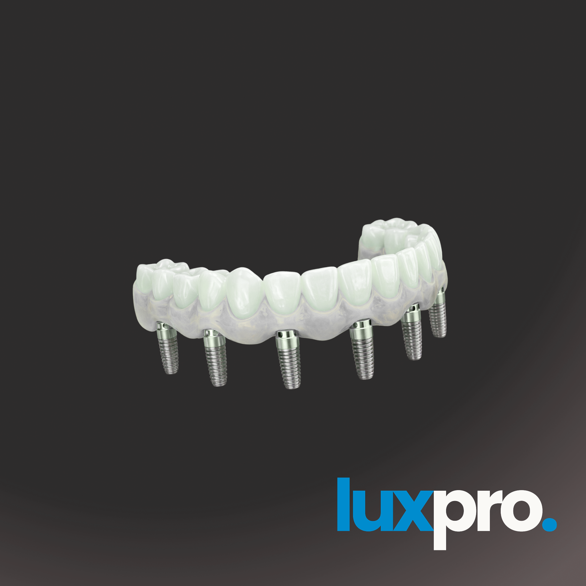 All-on-X Full-Arch Implant Restoration