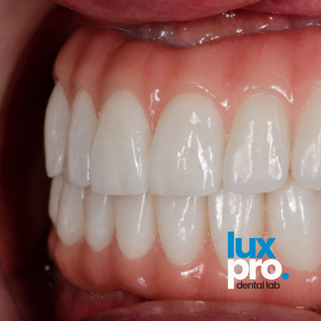 All-on-X Full-Arch Implant Restoration