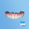 All-on-X Full-Arch Implant Restoration