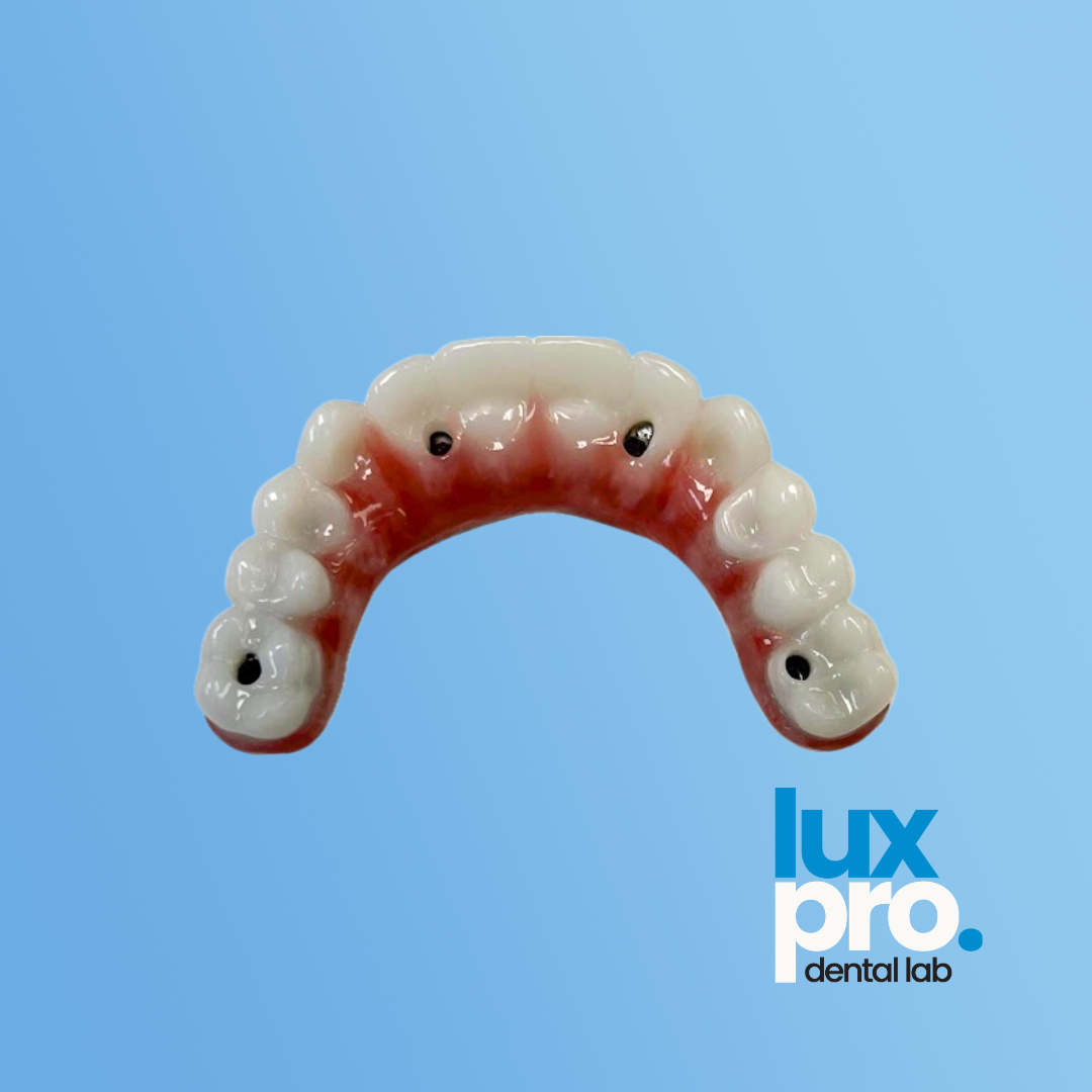 All-on-X Full-Arch Implant Restoration