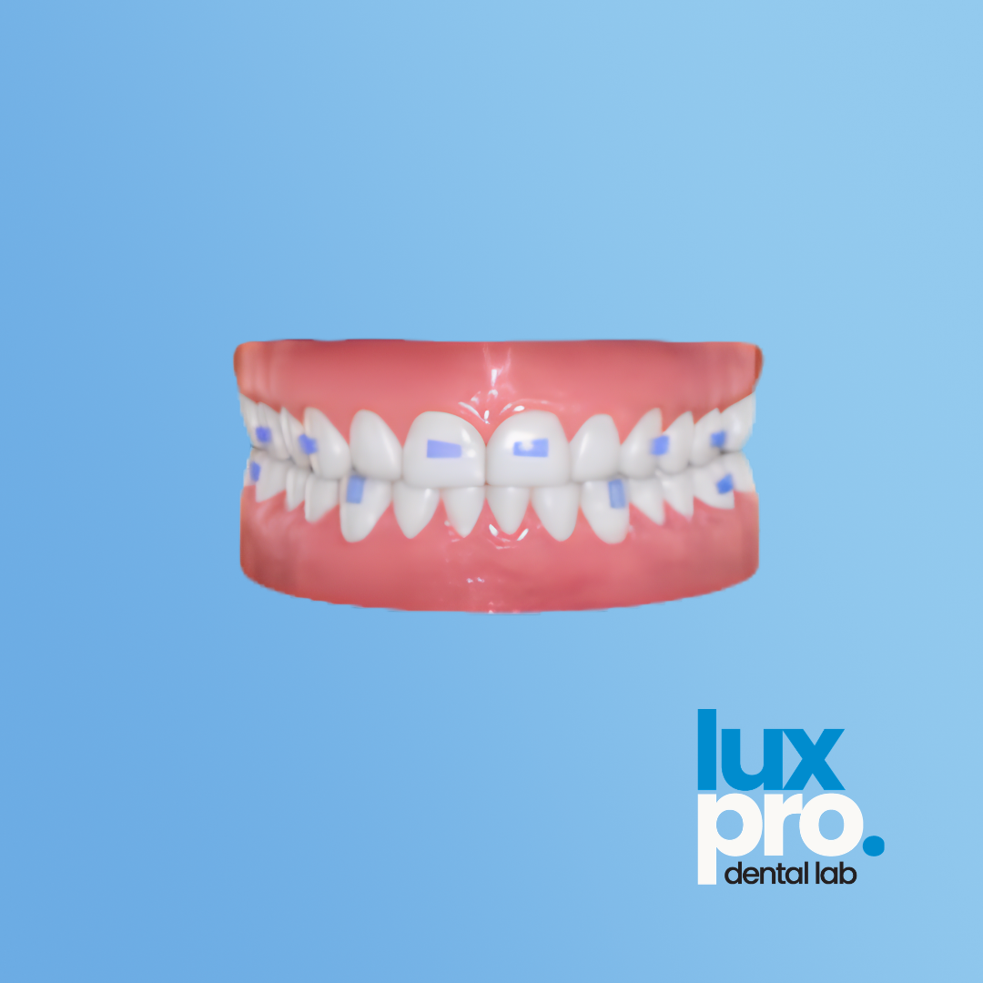 Clear Aligner Treatment Plan