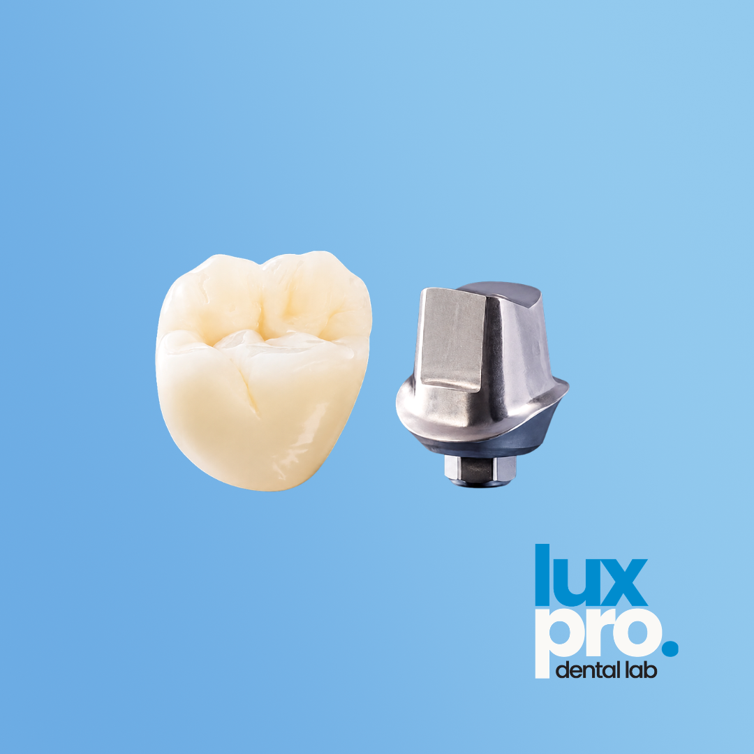 Complete Cement-Retained Implant Restoration