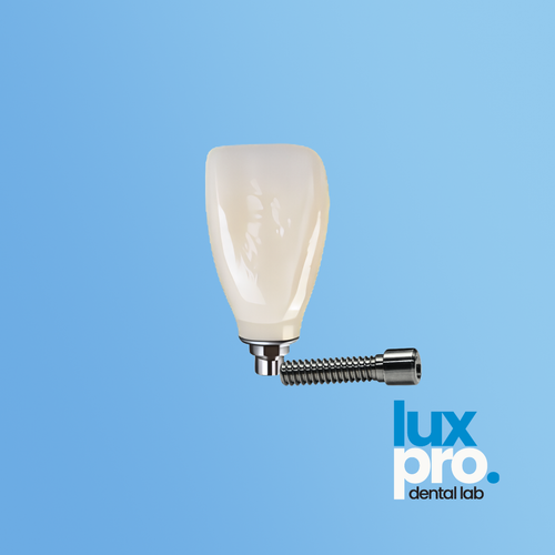 Complete Screw-Retained Implant Restoration