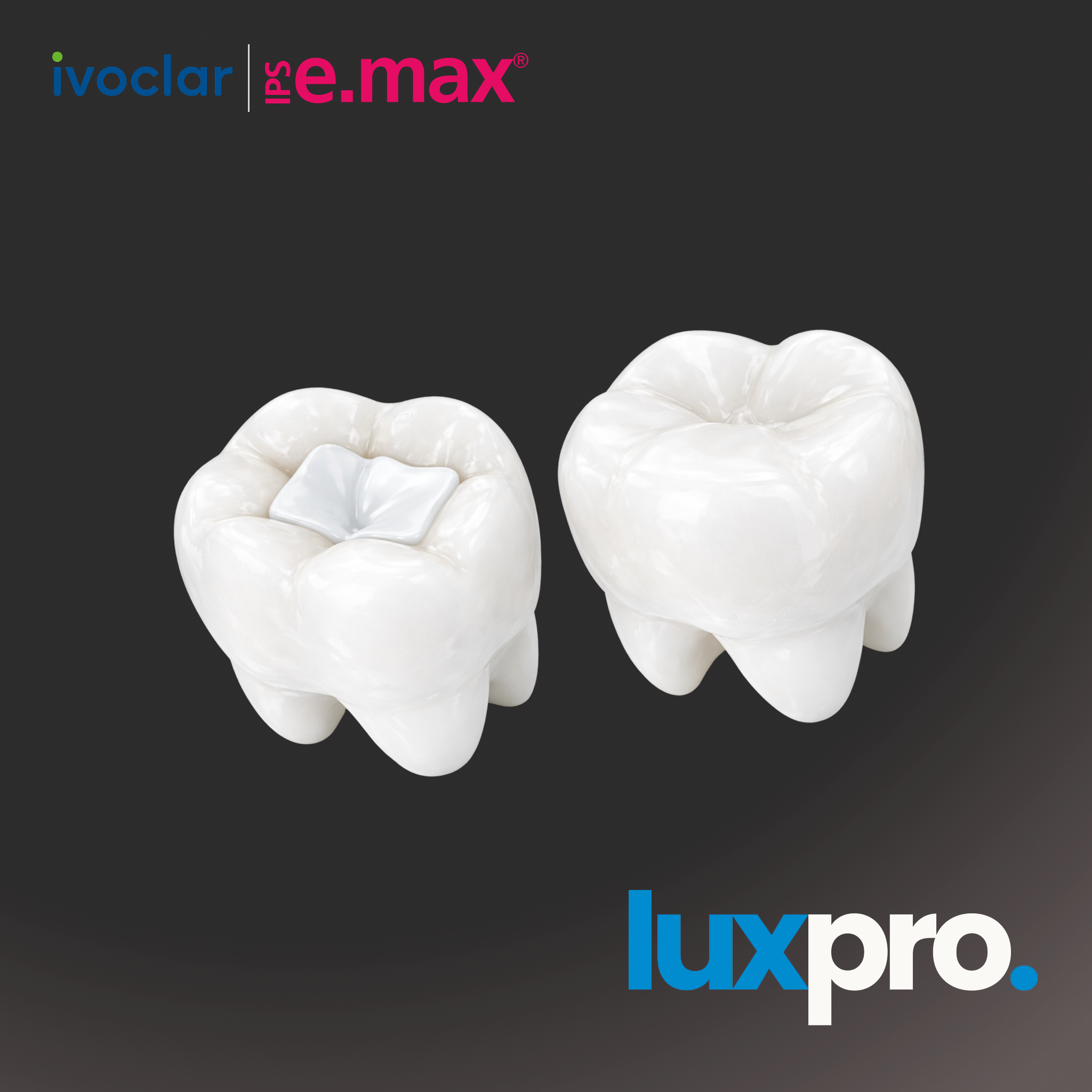 IPS e.max Inlays & Onlays