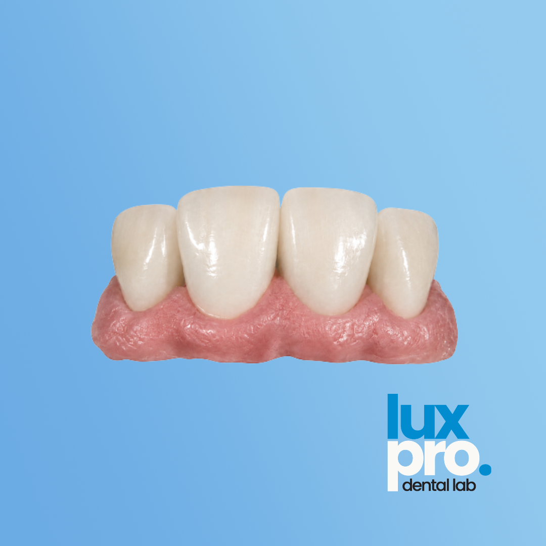 Full Zirconia High-Strength Crowns
