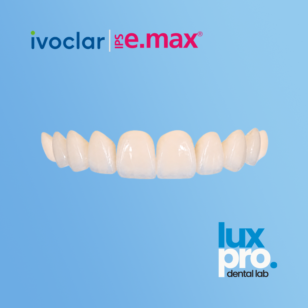 IPS e.max Veneers